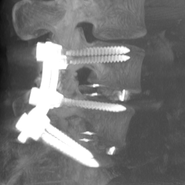Так на компьютерной томофграфии выглядит поясничный отдел позвоночника после хирургической реконструкции в связи с запущенным остеохондрозом и полным разрушением межпозвоночных дисков - вид сбоку