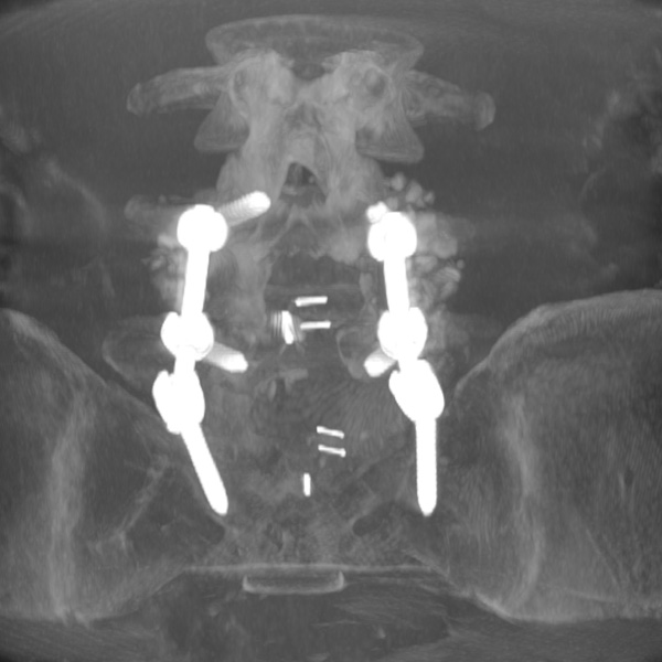 Поясничный отдел позвоночника после хирургической операции в связи с запущенным остеохондрозом и полным разрушением межпозвоночных дисков